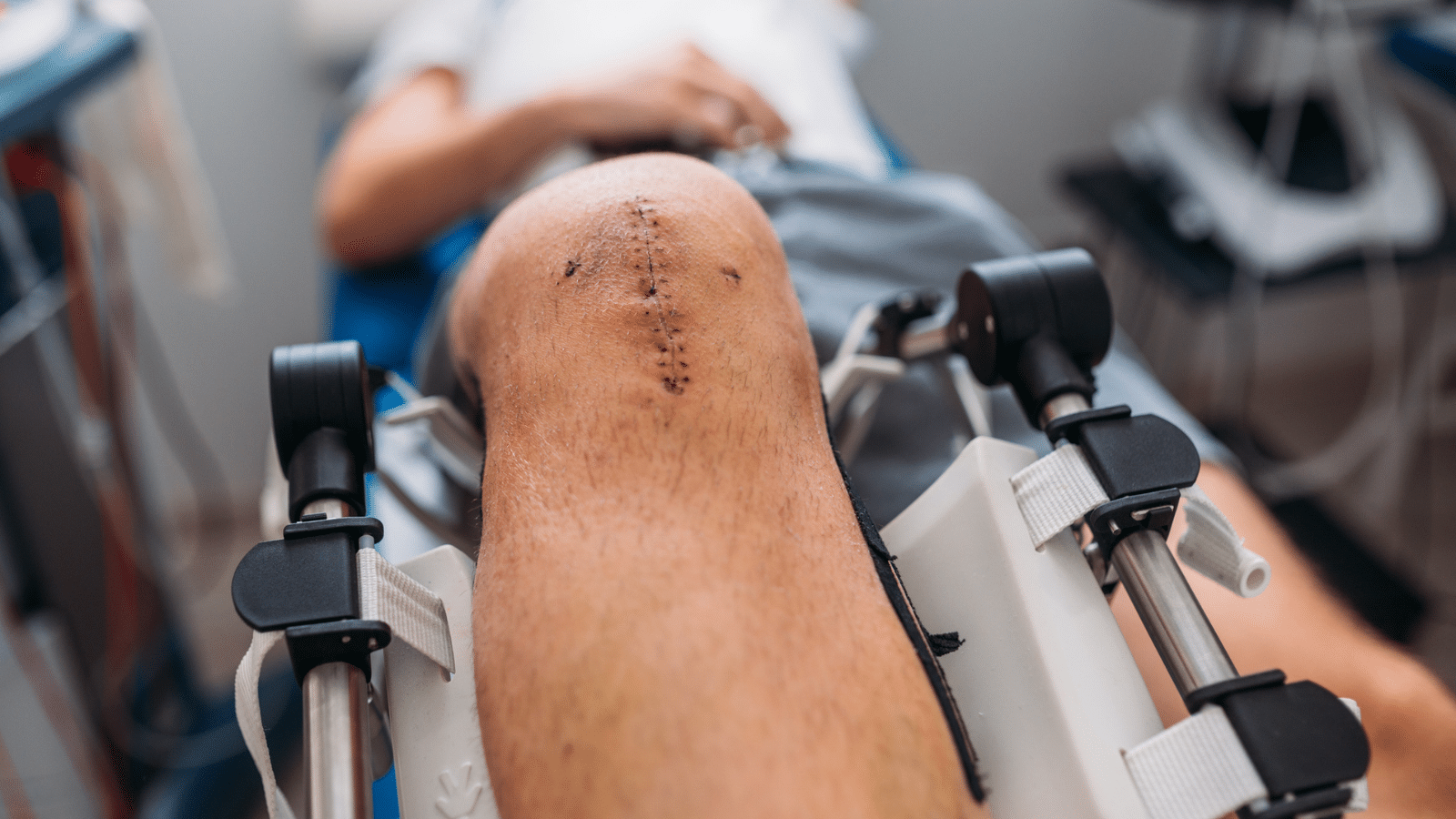 Close-up Of A Patient's Scar After Knee Surgery - joint replacement
